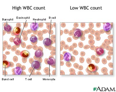 Leukocytosis - an increase in the number of white cells in the blood, especially during an infection Source: http://emedicine.medscape.com/