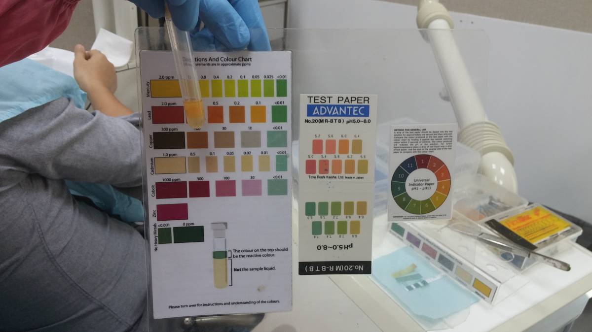 Colour chart shows that N had 2.0ppm mercury is his saliva, which is a pretty high concentration for only 3 small mercury fillings. Depending on what heavy metals you have been exposed to, the saliva will turn a different colour upon reaction with the reagent.